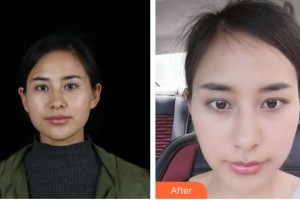 揚州施爾美醫(yī)療美容醫(yī)院李微整形價格表附微針水光案例展示