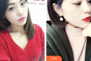 揚州華美整形美容醫(yī)院高軍飛整形價格表附光子嫩膚案例展示