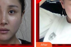 揚(yáng)州微創(chuàng)醫(yī)院整形美容中心潘玉珍整形價(jià)格表附美白導(dǎo)入案例展示