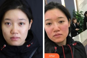 揚(yáng)州施爾美醫(yī)療美容醫(yī)院張玉華整形價(jià)格表附微針美膚案例展示