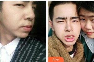 揚(yáng)州艾菲斯醫(yī)療美容門診部羅田田整形價(jià)格表附金屬托槽矯正案例展示