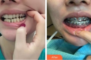 揚州貝恩口腔醫(yī)院魏波整形價格表附牙齒陶瓷矯正案例展示