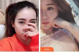 揚州貝恩口腔醫(yī)院車蓓整形價格表附牙齒隱形矯正案例展示