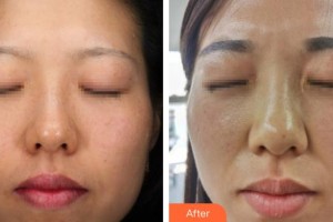 荊州迪亞羅蘭醫(yī)療美容門診部羅蘭整形價(jià)格表附光子嫩膚案例展示