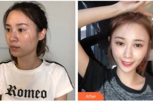 荊州迪亞羅蘭醫(yī)療美容門診部李軍整形價(jià)格表附去痘印痘坑案例展示