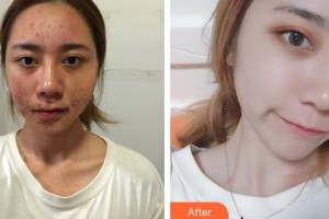 荊州普愛康復(fù)醫(yī)院彭義坤整形價(jià)格表附紅藍(lán)光祛痘案例展示