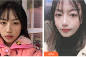 荊州市第一人民醫(yī)院整形美容科張俊整形價(jià)格表附微創(chuàng)疤痕修復(fù)案例展示