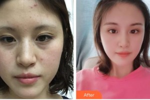 荊州市中心醫(yī)院整形美容外科田方興 整形價(jià)格表附激光祛斑案例展示