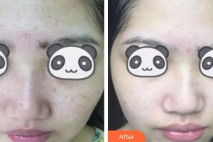 荊州中愛醫(yī)療整形美容門診部楊明明整形價(jià)格表附黑臉娃娃案例展示