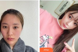 荊州市中心醫(yī)院整形美容外科董潔整形價(jià)格表附激光祛疤案例展示