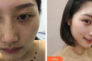 荊州中愛醫(yī)療整形美容門診部陳志鵬整形價(jià)格表附紅藍(lán)光祛痘案例展示