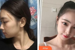 荊州普愛康復(fù)醫(yī)院聶忠整形價(jià)格表附激光祛疤案例展示