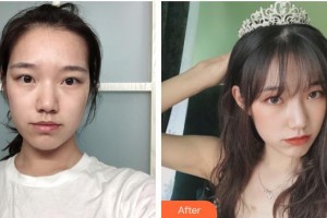 荊州美傲醫(yī)療美容診所黃誠斌整形價(jià)格表附微創(chuàng)疤痕修復(fù)案例展示