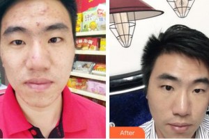 荊州市第二人民醫(yī)院整形激光美容中心劉兵整形價(jià)格表附紅藍(lán)光祛痘案例展示