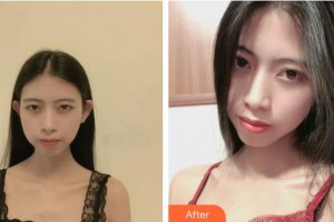 荊州華美整形美容醫(yī)院王懿整形價(jià)格表附去痘印痘坑案例展示