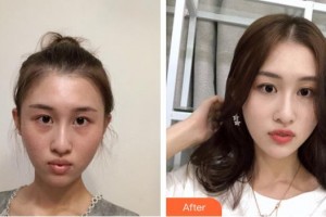 荊州中愛醫(yī)療整形美容門診部李林整形價(jià)格表附去痘印痘坑案例展示