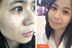 荊州市中心醫(yī)院整形美容外科文漢東 整形價(jià)格表附激光祛斑案例展示