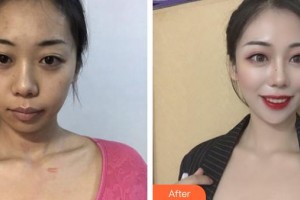 荊州市中心醫(yī)院整形美容外科王圣早整形價(jià)格表附微創(chuàng)疤痕修復(fù)案例展示