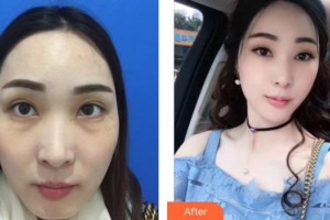 荊州華美整形美容醫(yī)院沈沛整形價(jià)格表附激光去眼袋案例展示