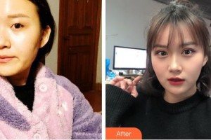 荊州華夏眼科醫(yī)院羅中華整形價(jià)格表附切開雙眼皮案例展示