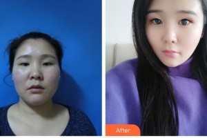 荊州華夏眼科醫(yī)院黃毅整形價(jià)格表附眼部綜合案例展示