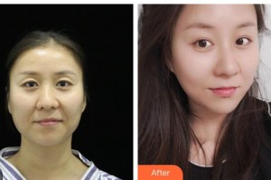 荊州市婦幼保健院眼科何維銘整形價(jià)格表附眼部修復(fù)案例展示