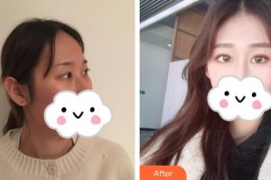 荊州市婦幼保健院眼科張進(jìn)整形價(jià)格表附眼部綜合案例展示