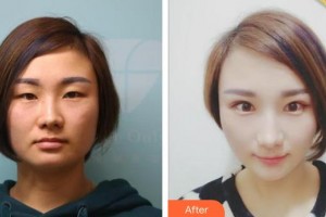 荊州市婦幼保健院眼科王百祥整形價(jià)格表附埋線雙眼皮案例展示