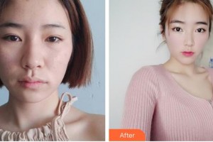 黃岡皇氏醫(yī)療美容醫(yī)院王全俊整形價(jià)格表附埋線提升案例展示