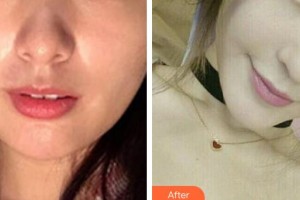 黃岡皇氏醫(yī)療美容醫(yī)院王金州整形價(jià)格表附埋線提升案例展示