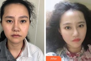 黃岡韓美醫(yī)療美容診所馮先才整形價(jià)格表附埋線提升案例展示