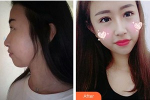 黃岡愛爾眼科醫(yī)院張麗整形價(jià)格表附眼部綜合案例展示