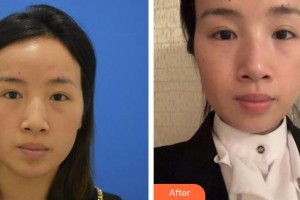 黃岡愛爾眼科醫(yī)院方敏整形價(jià)格表附激光去眼袋案例展示