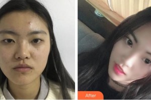 黃岡愛爾眼科醫(yī)院高小峰整形價(jià)格表附切開雙眼皮案例展示