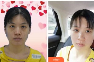 黃岡愛爾眼科醫(yī)院馮桂鳳整形價(jià)格表附激光去眼袋案例展示