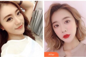 黃岡愛爾眼科醫(yī)院汪萍整形價(jià)格表附開外眼角案例展示