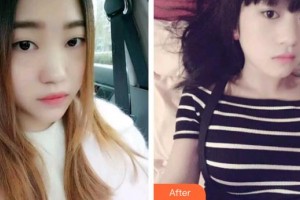 黃岡皓雅口腔醫(yī)院劉明文整形價(jià)格表附金屬托槽矯正案例展示