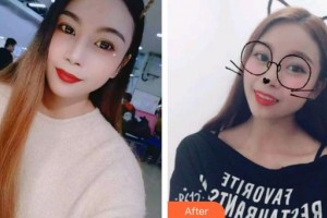 黃岡皓雅口腔醫(yī)院王丹整形價(jià)格表附牙貼面案例展示