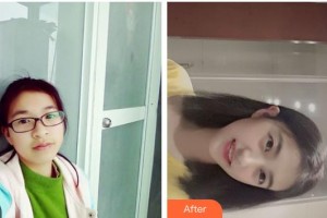 黃岡皓雅口腔醫(yī)院馮其輝整形價(jià)格表附金屬托槽矯正案例展示