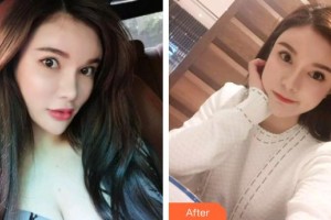 黃岡皓雅口腔醫(yī)院陳倩整形價(jià)格表附超聲波潔牙案例展示