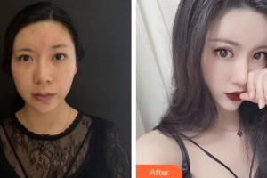 黃岡市中醫(yī)醫(yī)院燒傷整形科謝彬整形價(jià)格表附埋線提升案例展示