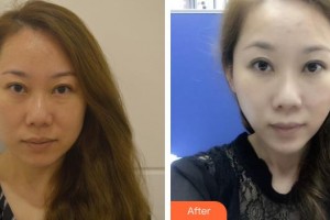 黃岡市中醫(yī)醫(yī)院燒傷整形科范聲強(qiáng)整形價(jià)格表附埋線提升案例展示