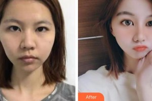 黃岡市中醫(yī)醫(yī)院燒傷整形科方華整形價(jià)格表附熱拉提案例展示