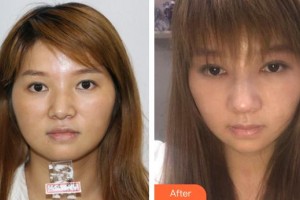 隨州艾琳醫(yī)療美容診所艾琳整形價格表附假體隆鼻案例展示