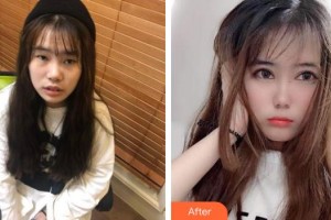 隨州愛爾眼科醫(yī)院阮海晶整形價格表附切開雙眼皮案例展示