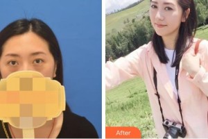 隨州愛爾眼科醫(yī)院李年爽整形價格表附開內(nèi)眼角案例展示