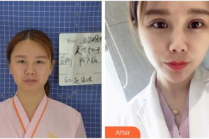 隨州愛爾眼科醫(yī)院劉莉整形價格表附眼部綜合案例展示