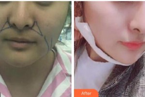 咸寧韓美醫(yī)療美容醫(yī)院段家海整形價格表附埋線提升案例展示