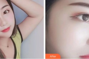 咸寧韓美醫(yī)療美容醫(yī)院鄢潮海整形價格表附熱拉提案例展示