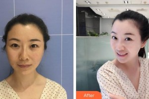 咸寧市中心醫(yī)院醫(yī)學(xué)美容中心周朝暉整形價格表附埋線提升案例展示